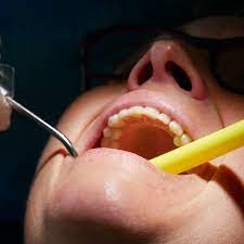 How to Know If You Need a Root Canal or Just a Filling?