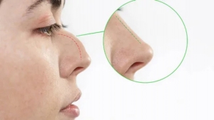 Transform Your Profile with Expert Rhinoplasty in Delhi  - Dr Vivek Kumar