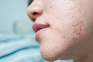 Skincare Mistakes That Make Acne Worse