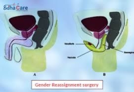 Gender Reassignment Surgery in India: Comprehensive Solutions with EdhaCare
