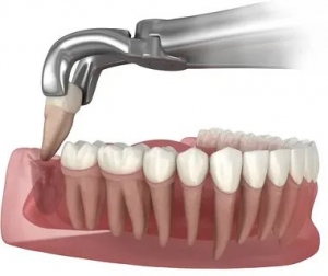 How I Managed Pain-Free Wisdom Teeth Removal in Bangalore