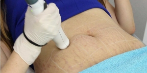 Top Signs You’re a Good Candidate for Laser Stretch Mark Removal:
