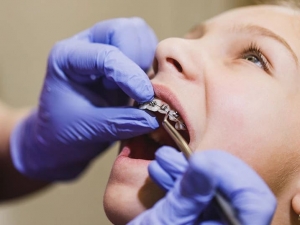 10 Dental Concerns Braces Can Manage