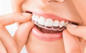 Top Benefits of Using Clear Aligners for Teeth Straightening