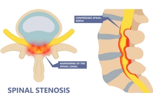 Understanding Spinal Stenosis: Relief, Treatment, and Regaining Mobility