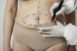 Liposuction Surgery- When to Go for It Before the Wedding
