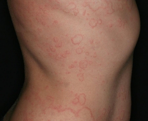 Chronic Spontaneous Urticaria Market Industry, Size, Share | Growth 2025-2033