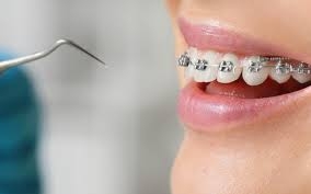 How to Take Care of Your Braces Properly?