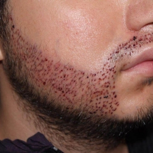 What You Should Know About Beard Hair Transplant Cost