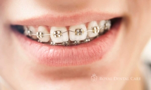 Why Regular Dental Teeth Cleaning Is Essential for Long-Term Oral Health
