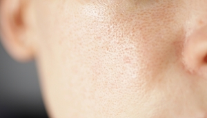 Open Pore Treatments: How to Shrink Pores?