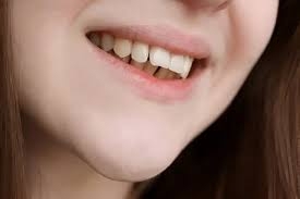 Is It Possible to Fix Protruding Teeth at Home?