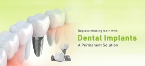 Transform Your Smile with Advanced Dental Implants at Aesthetic Smile Dental Clinic in India