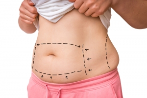 Target Trouble Spots with Laser Liposuction