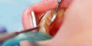 How Long Does It Take to Recover from Wisdom Tooth Surgery?