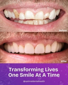 Teeth Whitening in London: Options, Costs & What to Consider