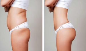 What to Expect Before and After Surgery from the Best Liposuction Doctor in Bhubaneswar?