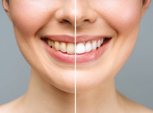Do Whitening Toothpastes Really Work?