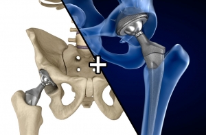 Joint Reconstruction Devices Market: Size, Trends, and Strategic Growth Insights