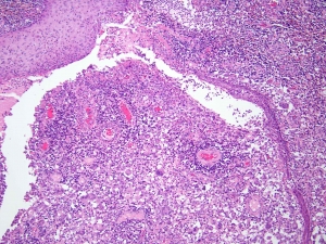 Hidradenitis Suppurativa Market Size, Trends, and Growth Forecast 2025-2032 Required