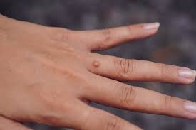 Fast, Safe, and Effective: Discover the Latest Warts Removal Techniques