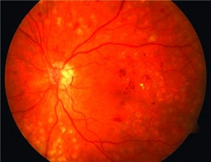 Proliferative Diabetic Retinopathy Market Size, Trends, and Growth Forecast 2025-2032