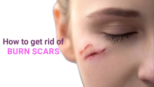 How to Get Rid of Burn Scar