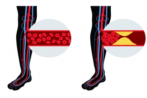 Peripheral Arterial Disease Market Size, Trends, and Strategic Outlook 2025-2032