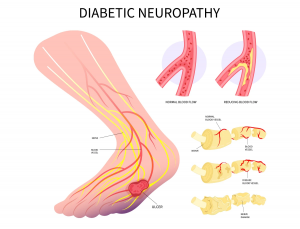 Diabetic Peripheral Neuropathy Market Size, Trends, and Growth Analysis 2025-2032
