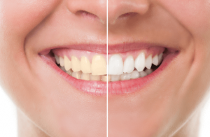 Teeth Whitening in Arlington, TX: Before and After Care Tips