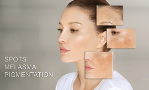 Melasma Pigmentation Treatments That Work