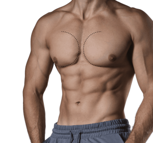 No More Embarrassment: Discover the Benefits of Gynecomastia Treatment