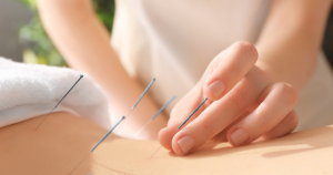 Why You Should Trust the Best Acupuncture Experts in Hamilton for Your Health Journey