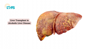 Liver Transplant in Alcoholic Liver Disease