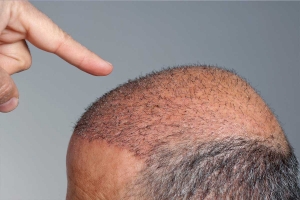 Unlock the Secrets of a Fuller, Thicker Hairline with DHI Hair Transplant