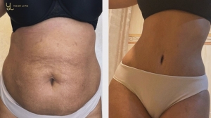Liposuction Cost and Options in South Africa | What You Need to Know