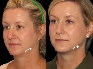 How Massaging After Sculptra Treatment in Dubai Influences Results