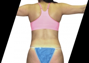 What Are the Advantages of a Body Contour Procedure in Houston?