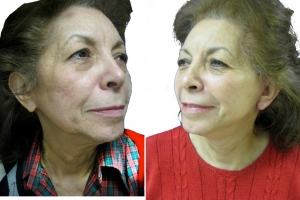 How to Choose Cosmetic Surgery Near You Smartly?