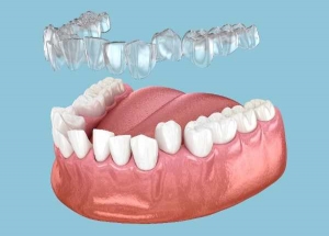Using Invisalign Cleaning Crystals Effectively in Norwich