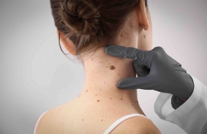 Can Cosmetic Mole Removal Improve Skin Appearance and Confidence?