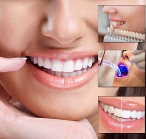 How Porcelain Veneers, Teeth Whitening, and Invisalign Can Transform Your Smile