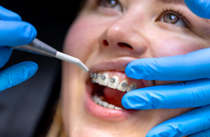 Transforming Smiles with Modern Dental Alignment Solutions