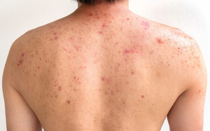 Back Acne Breakthroughs: Modern Treatments