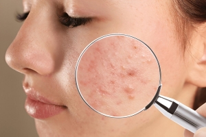 Can Lasers Help Get Rid of Acne?  