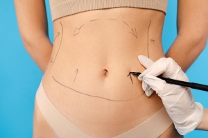 The Ultimate Guide to Tummy Tuck Surgery in Chicago