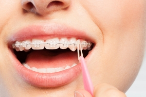 Average Braces Cost In Dover, DE What is the average cost of braces? 