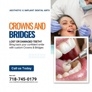 What Materials Are Used for Dental Crowns and Bridges?