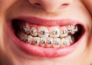 Braces for Adults: Exploring the Different Types and Their Lasting Benefits