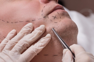 How Dramatic Are the Transformations from Beard Hair Transplant in Dubai?